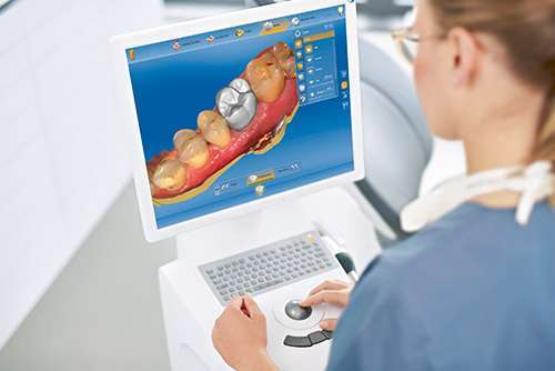 CEREC Zahnersatz in Wiesbaden - Erstellung des CAD/CAM-Modells