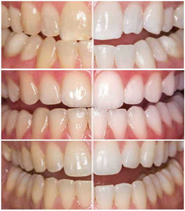 Bleaching Zahnaufhellung Mit Opalescence In Wiesbaden
