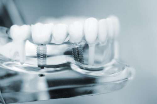 DENTAL IMPLANTS in Wiesbaden