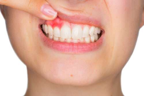 Periodontics / Periodontitis Treatment in Wiesbaden