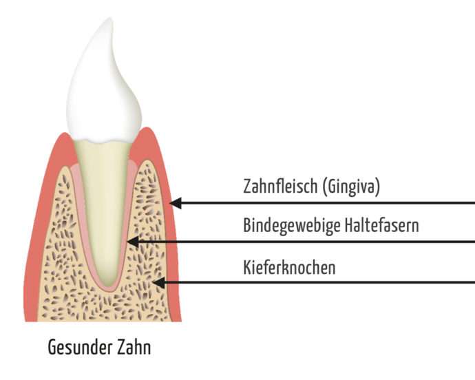 Parodontose Behandlung - Parodontitis gesunder-zahn