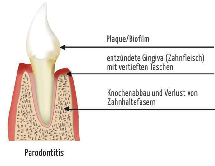 Parodontose Behandlung - Parodontitis in Wiesbaden